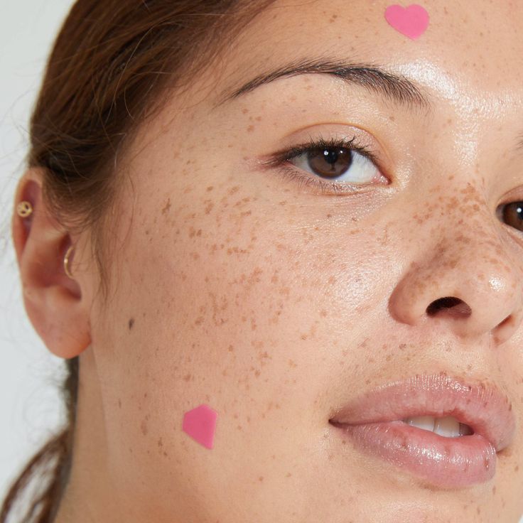 Why Treating Hormonal Acne Is About More Than Just Breakouts