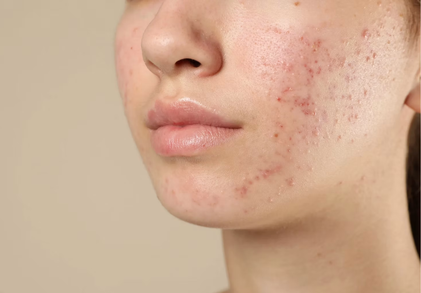 Removing acne scars 